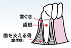 歯肉炎のイラスト