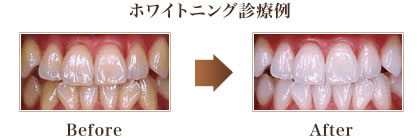 ホワイトニング診療例